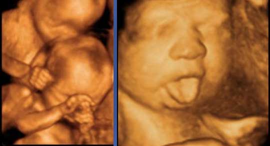 سونوگرافی سه بعدی در حاملگی