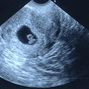 سونوگرافی هفته هفتم