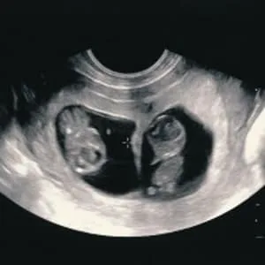 عکس سونوگرافی دوقلو جنین هفته ۹