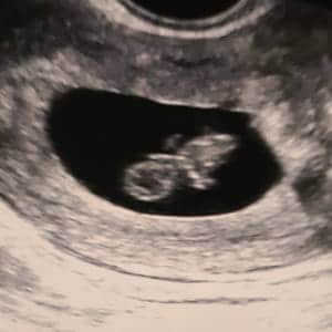 سونوگرافی هفته هشتم بارداری