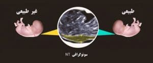 زیاد بودن عدد NT