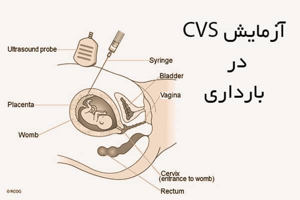 آزمایش CVS در بارداری